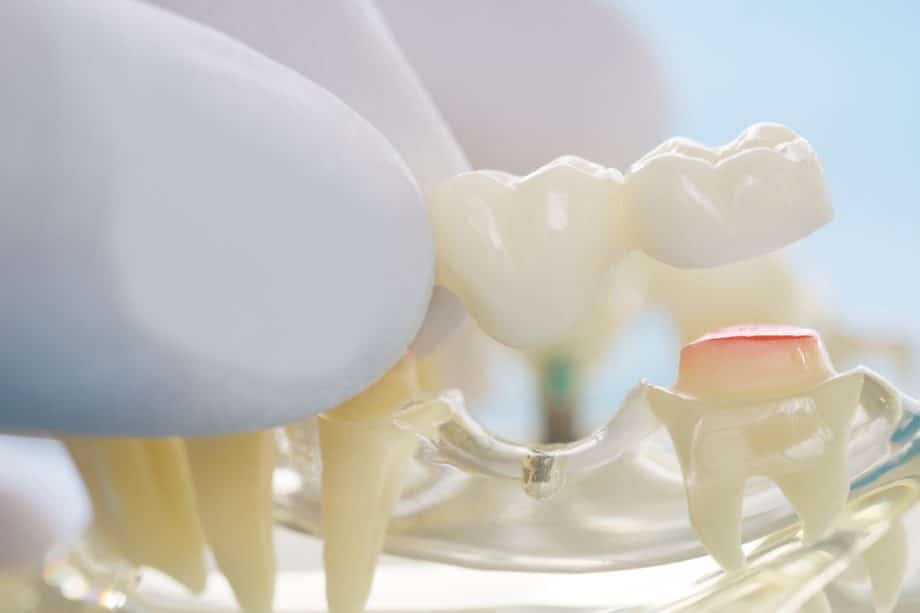 How Much Does A Dental Bridge Cost in Kingston, ON?