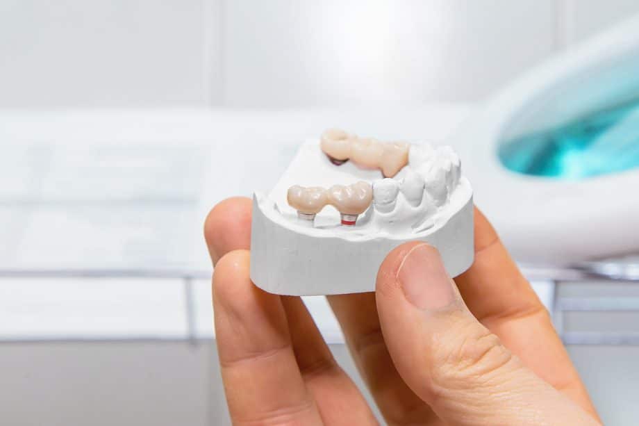 dental bridge on model of jaw